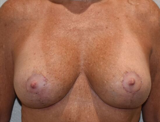 Breast Revision: Case 304 - After
