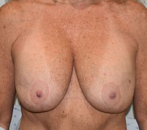 Breast Revision: Case 304 - Before