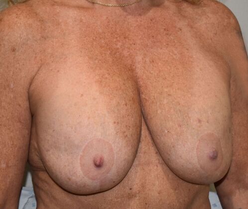 Breast Revision: Case 304 - Before