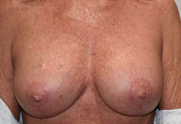 Breast Revision: Case 290 - After