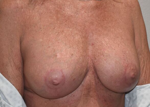 Breast Revision: Case 290 - After