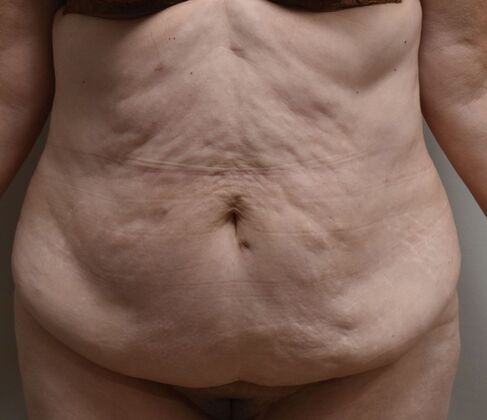 Tummy Tuck (Abdominoplasty): Case 543 - Before