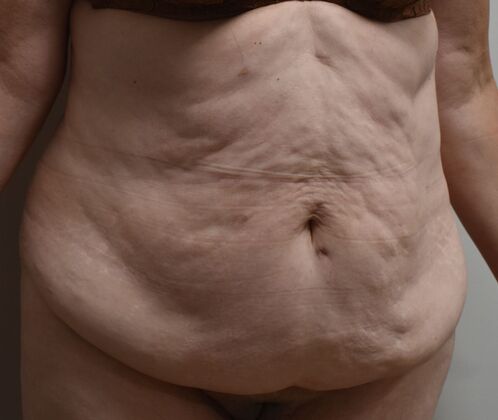Tummy Tuck (Abdominoplasty): Case 543 - Before