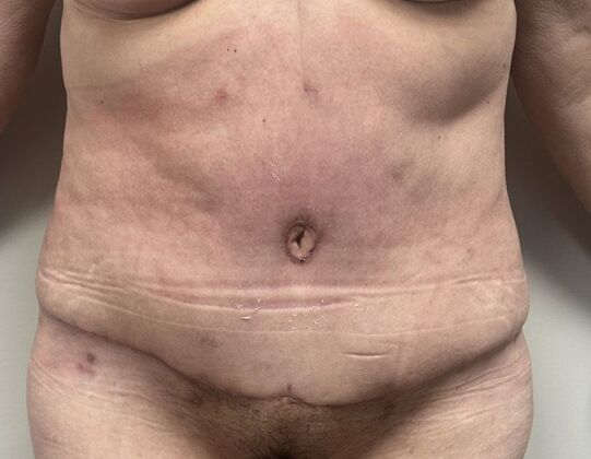 Tummy Tuck (Abdominoplasty): Case 543 - After