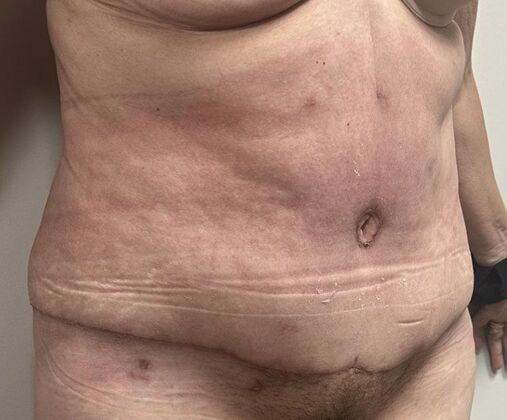 Tummy Tuck (Abdominoplasty): Case 543 - After