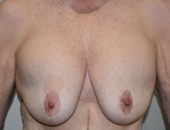 Breast Implant Removal: Case 57 - Before