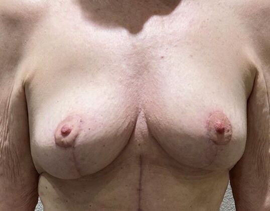 Breast Implant Removal: Case 57 - After