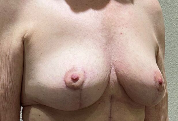 Breast Implant Removal: Case 57 - After