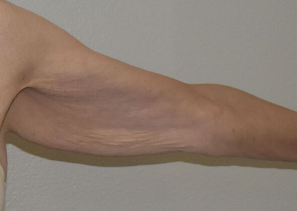 Brachioplasty Case 24 - Before