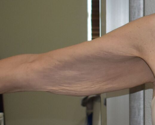 Brachioplasty: Case 24 - Before