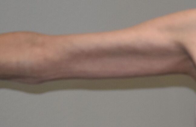 Brachioplasty: Case 24 - After