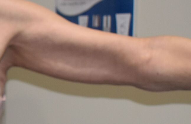 Brachioplasty Case 24 - After