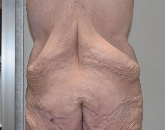 Massive Weight Loss : Case 181 - Before