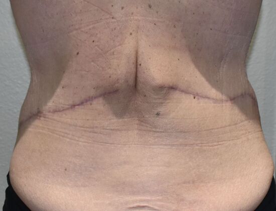Massive Weight Loss : Case 181 - After