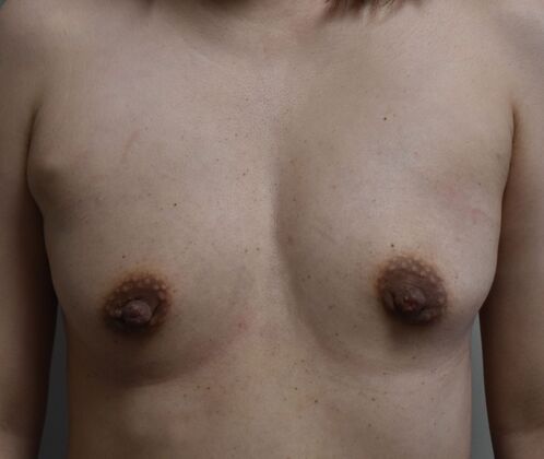 Breast Augmentation Case 796 - Before