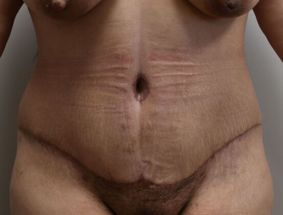 Tummy Tuck (Abdominoplasty) Case 537 - After