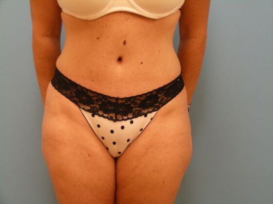 Tummy Tuck Case 11 - After