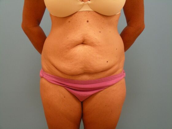 Tummy Tuck Case 11 - Before