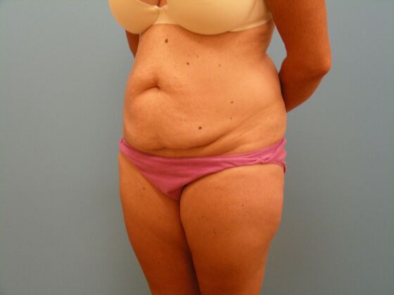 Tummy Tuck: Case 11 - Before