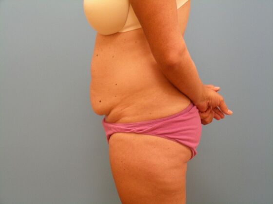 Tummy Tuck: Case 11 - Before