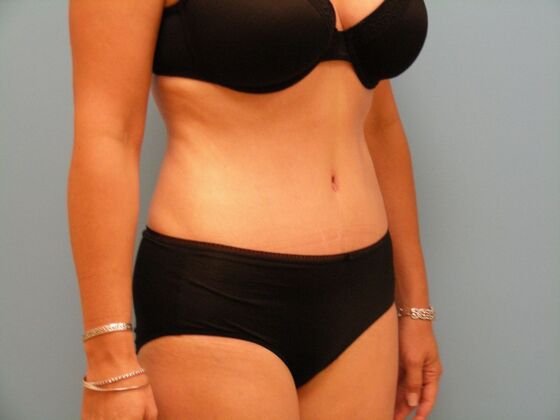 Tummy Tuck: Case 12 - After