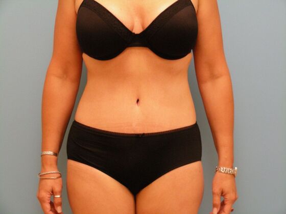 Tummy Tuck Case 12 - After