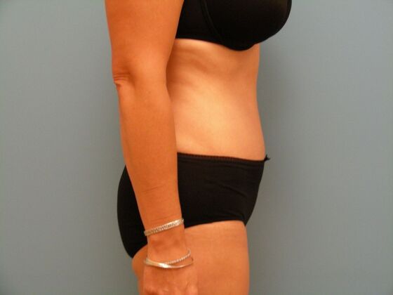 Tummy Tuck: Case 12 - After