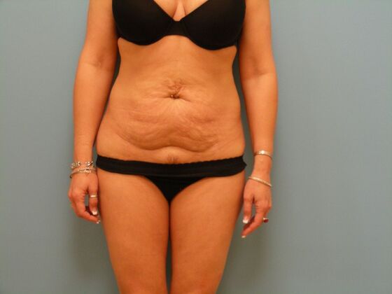 Tummy Tuck Case 12 - Before