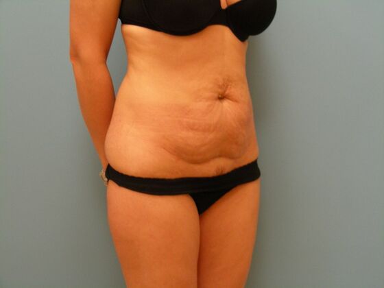 Tummy Tuck: Case 12 - Before