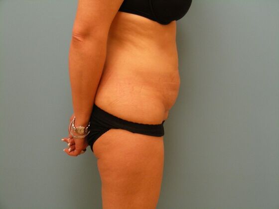 Tummy Tuck: Case 12 - Before