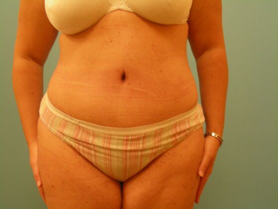 Tummy Tuck Case 13 - After