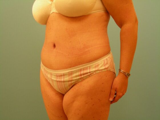 Tummy Tuck: Case 13 - After