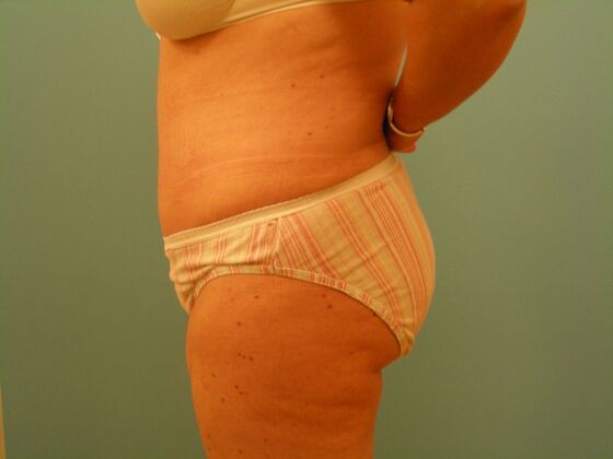 Tummy Tuck: Case 13 - After
