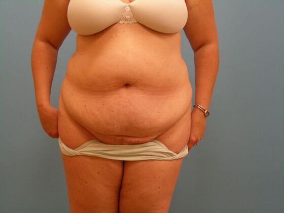 Tummy Tuck Case 13 - Before