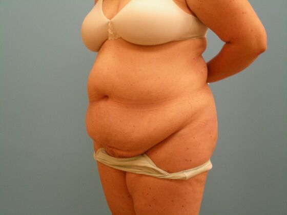 Tummy Tuck: Case 13 - Before