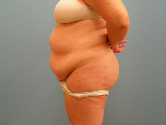 Tummy Tuck: Case 13 - Before