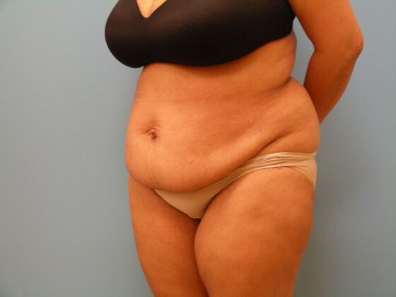 Tummy Tuck: Case 14 - Before