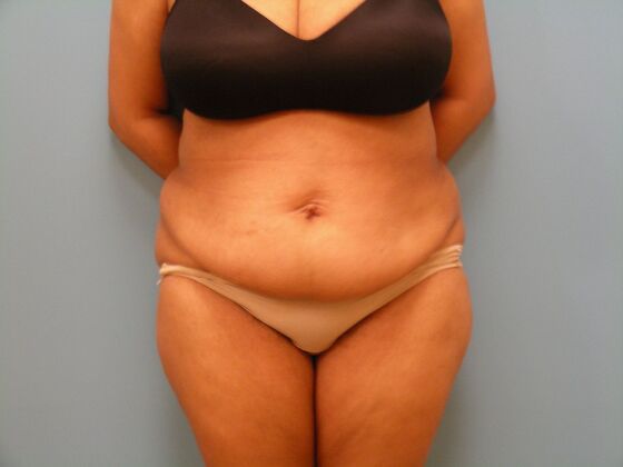 Tummy Tuck Case 14 - Before