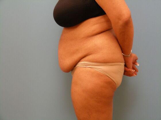 Tummy Tuck: Case 14 - Before