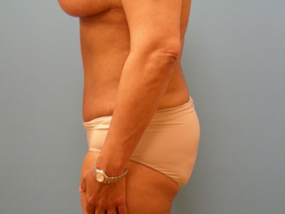 Tummy Tuck: Case 14 - After