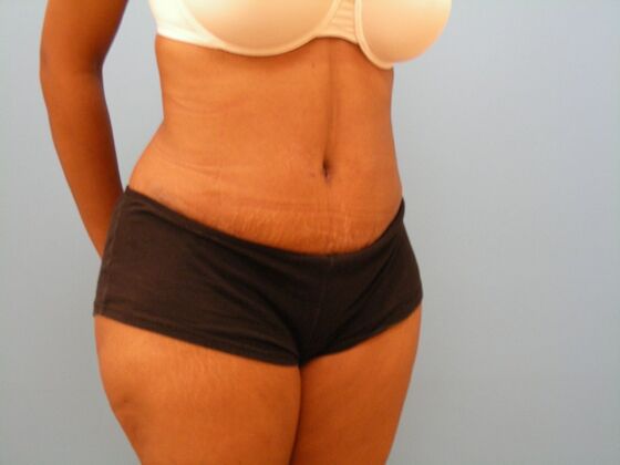 Tummy Tuck: Case 6 - After