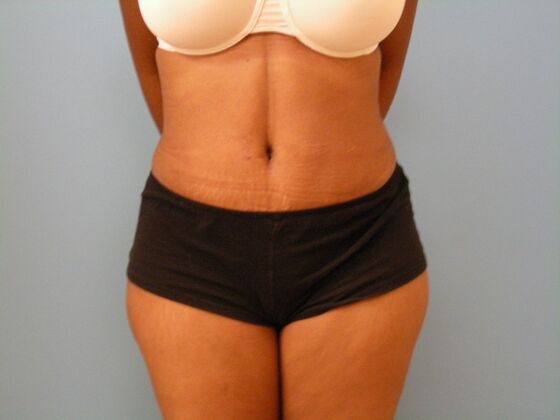Tummy Tuck Case 6 - After