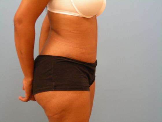 Tummy Tuck: Case 6 - After