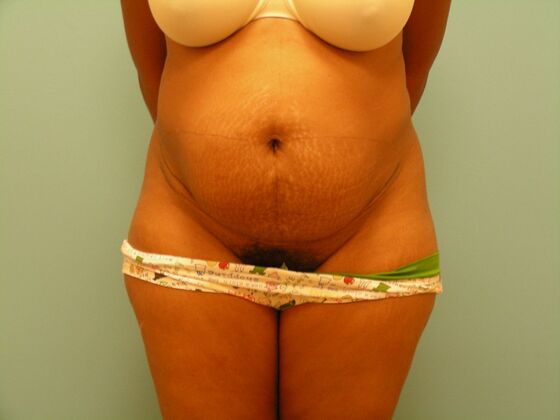 Tummy Tuck Case 6 - Before