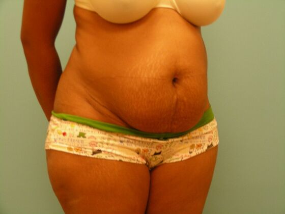 Tummy Tuck: Case 6 - Before