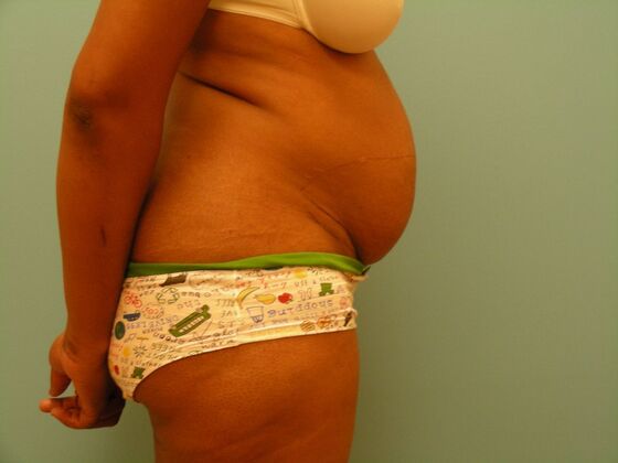 Tummy Tuck: Case 6 - Before