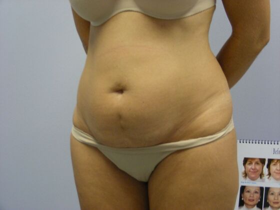 Tummy Tuck: Case 7 - Before