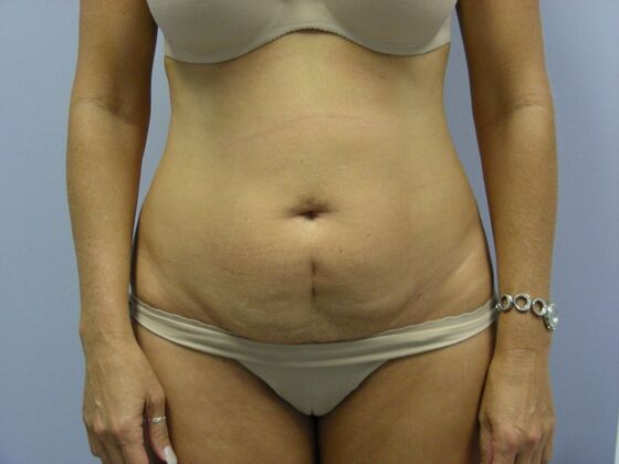 Tummy Tuck Case 7 - Before