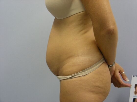 Tummy Tuck: Case 7 - Before