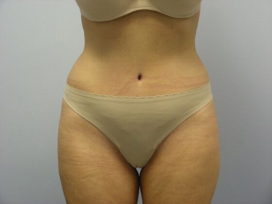 Tummy Tuck Case 7 - After